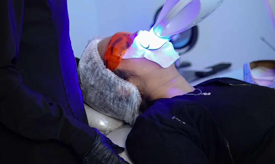 Blanqueamiento Dental Láser: Todo lo que necesitas saber sobre este procedimiento