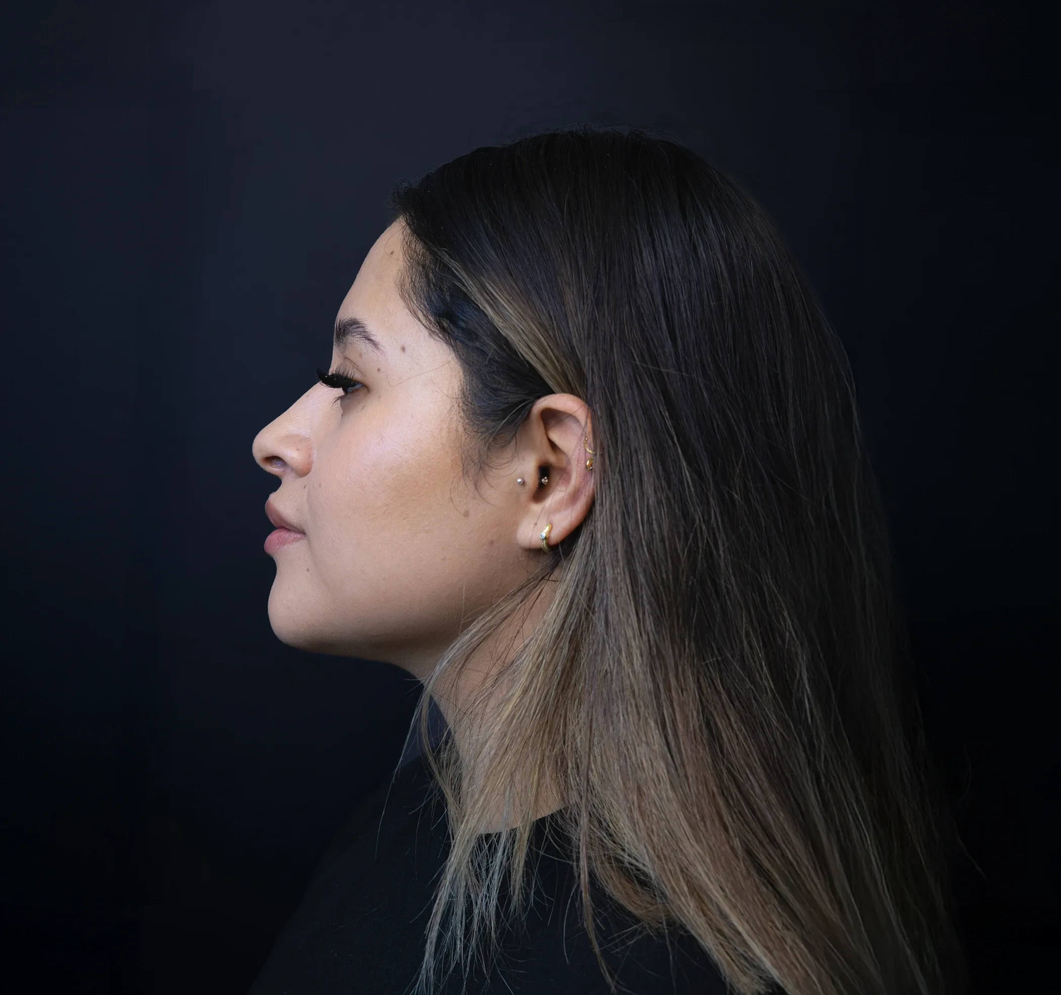 Rinomodelación con ácido hialurónico