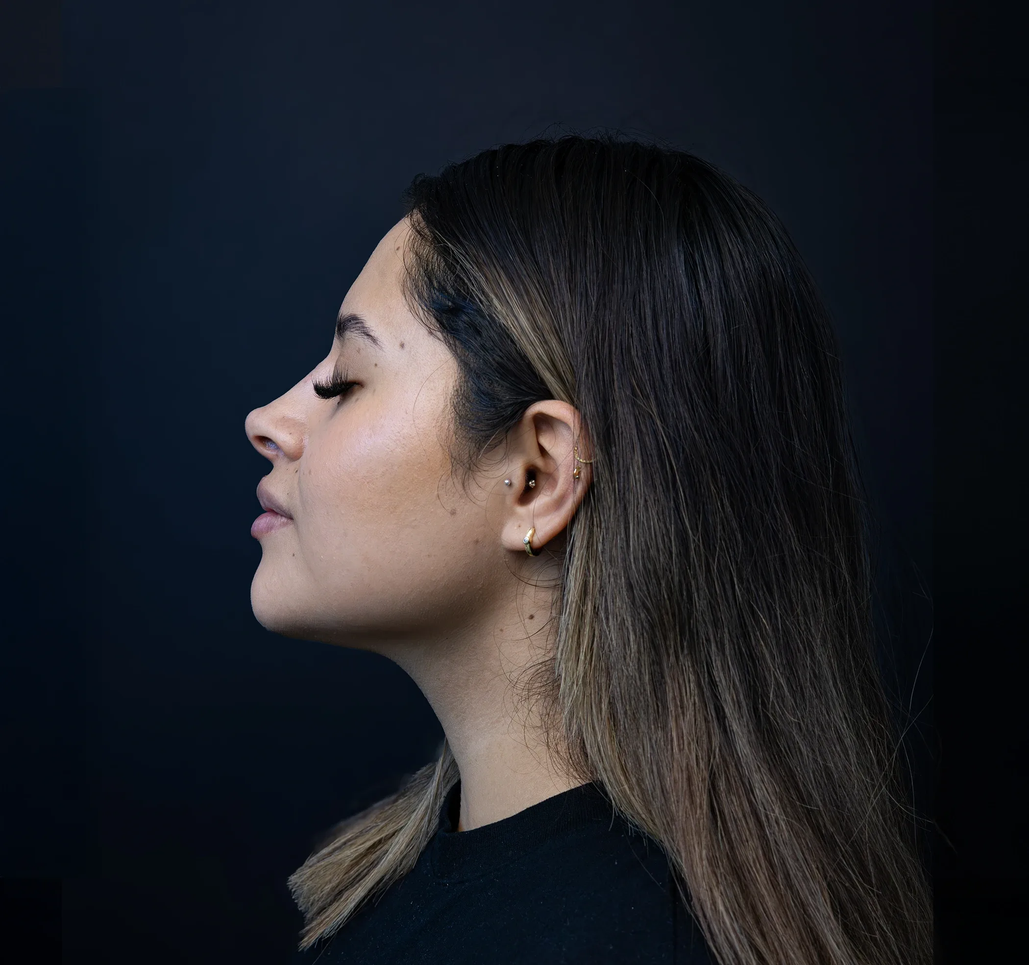 Rinomodelación con ácido hialurónico