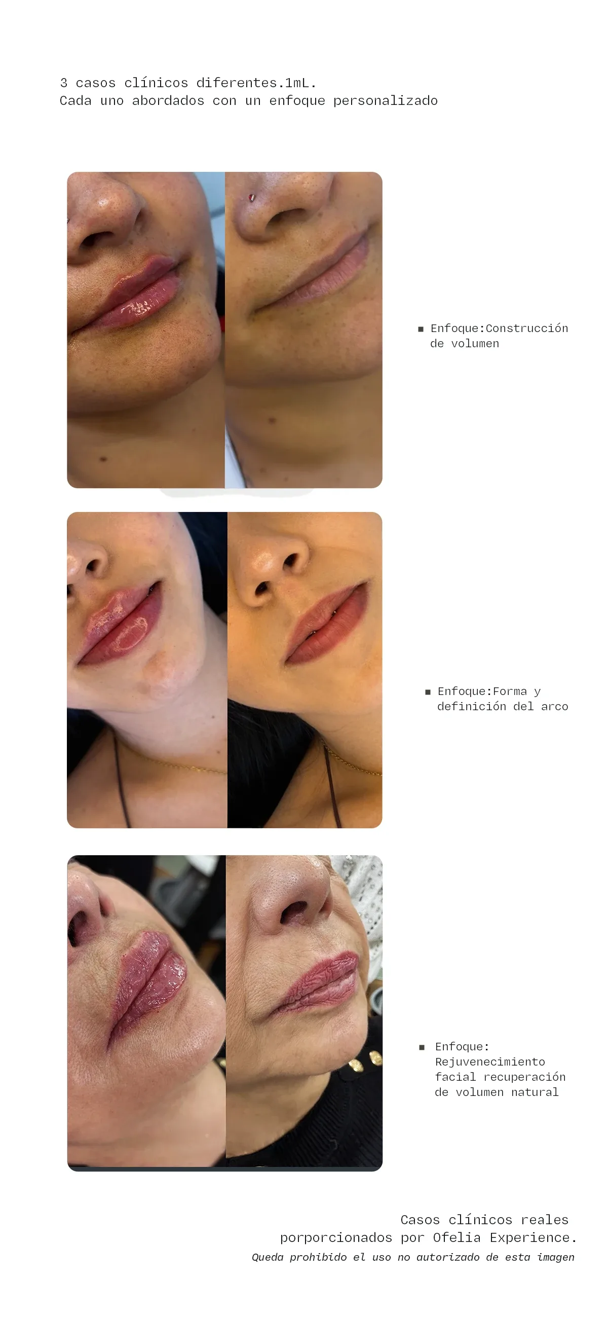 Dos pacientes con la misma cantidad (1 mL) de ácido hialurónico en labios — resultados distintos por diferencia anatómica. Ofelia Experience.