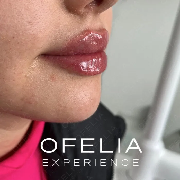 Resultado del Curso de Técnica Russian Lips: Relleno de Labios Avanzado