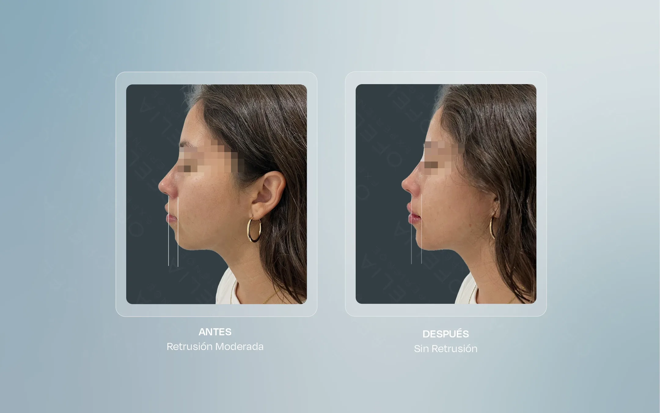 erfil facial de paciente antes y después de proyección de mentón con ácido hialurónico 