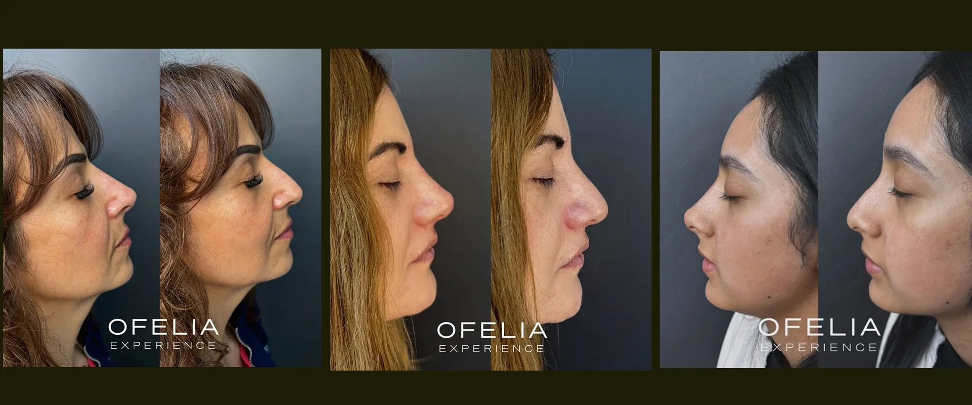 Antes y después de rinomodelación de punta caída en Ofelia Experience, Querétaro